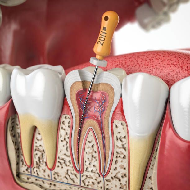 ENDODONCIA EN SONSECA