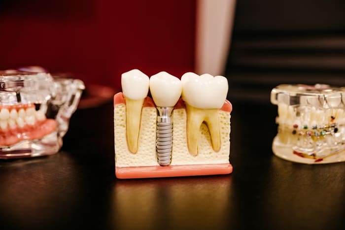 IMPLANTES DENTALES EN SONSECA